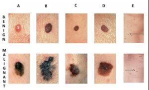 Differences-between-benign-and-malignant-moles-or-blemishes